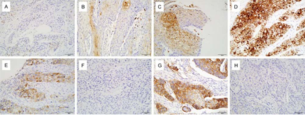 Representative pictures of IHC staining of HIF-1α, COX-2 and PD-L1 in tissue sections of ESCC.