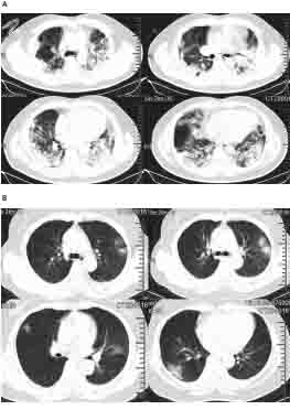 Chest CT images